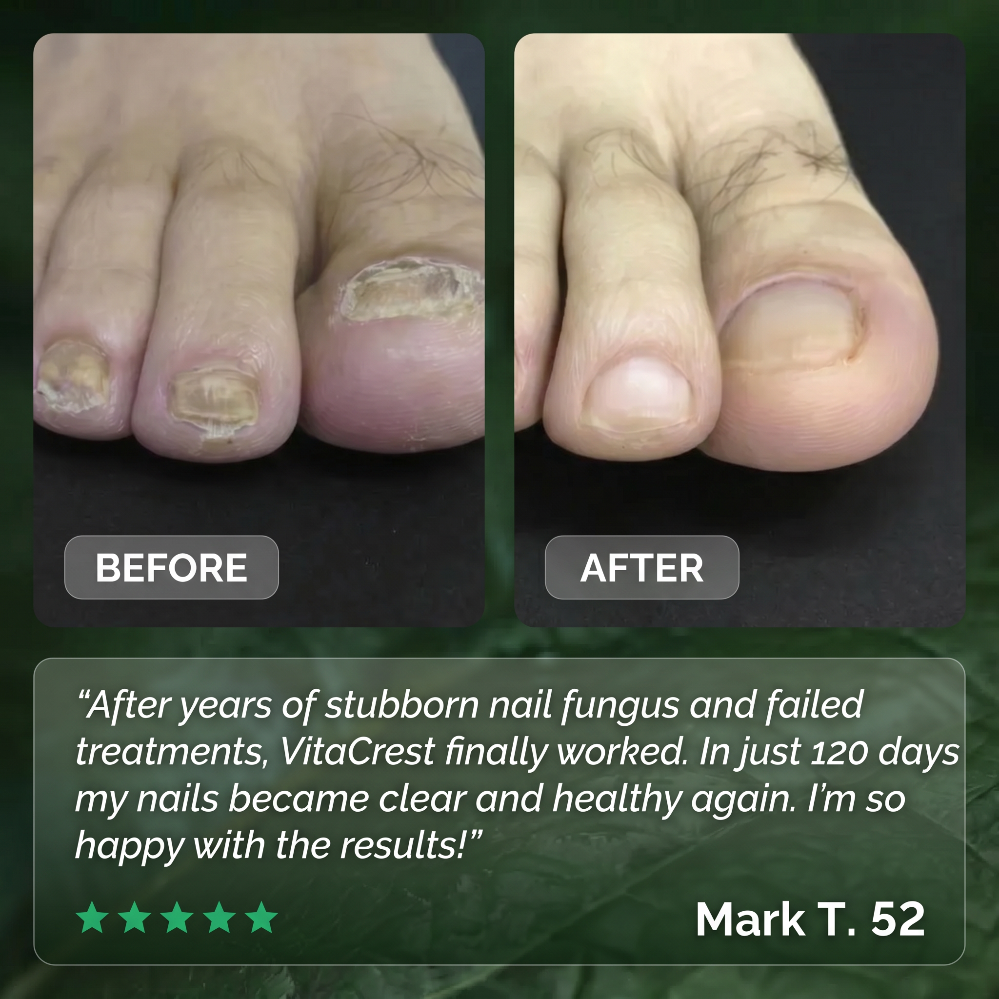 Anti-Fungal Nail Patches