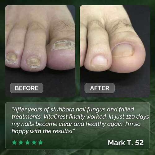 Anti-Fungal Nail Patches
